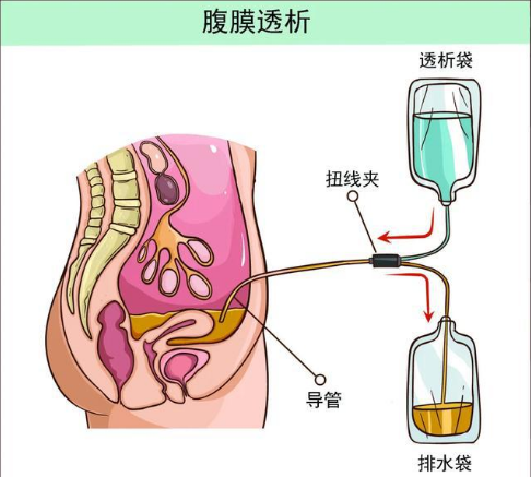 家用透析機(jī)