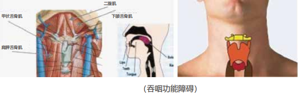 吞咽障礙治療儀1.png
