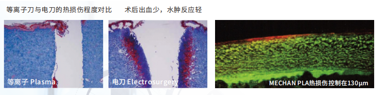 耳鼻喉低溫等離子1.png