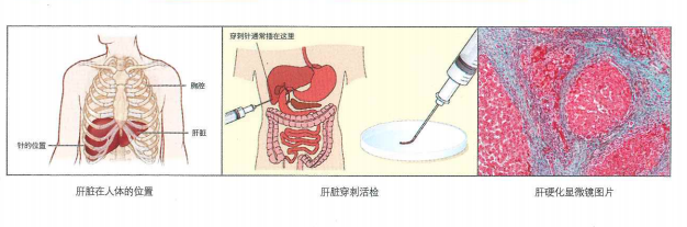 超聲肝硬化
