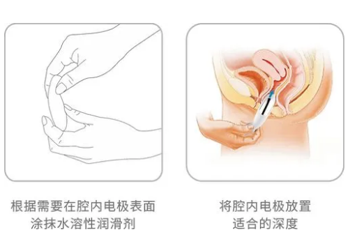 盆底肌探頭