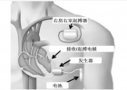 起搏器價(jià)格和換電池費(fèi)用