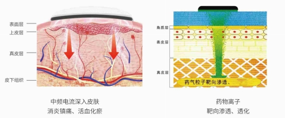 中頻治療儀原理