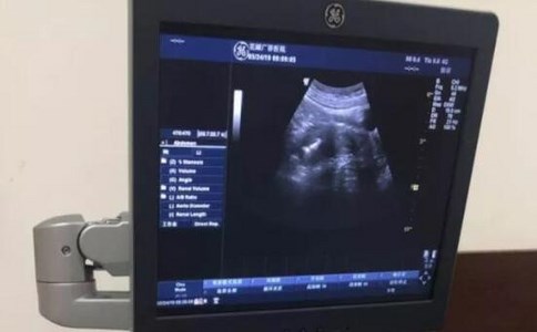 陰道B超 陰道B超